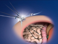 Eine chirurgische Technik über den Nabel: Sanfte Entfernung der Gallenblase und kaum sichtbare Narbe  