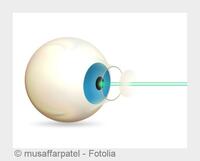 Augen lasern mit LASIK bei Augenarzt in Düsseldorf