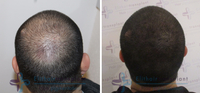 Haarpigmentierung - eine ideale Lösung bei Haarausfall