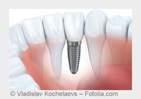Zahnimplantate in moderner Zahnarzt Praxis bei Kaiserslautern