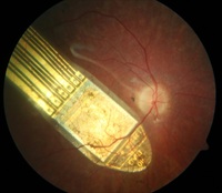Erste Studienergebnisse zu RETINA IMPLANT Alpha AMS veröffentlicht