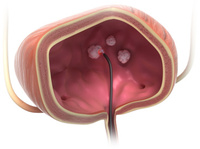 biolitecÂ®: Blasentumore jetzt mit Trans-Urethraler Laserablation TULAÂ® ambulant behandeln