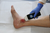 Neue Technik ist die Hoffnung für 3 Millionen Patienten mit offenen Wunden