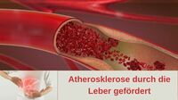 Atherosklerose durch die Leber gefördert