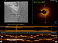 Invasive Kardiologie: Was ist eine Herzkatheteruntersuchung?